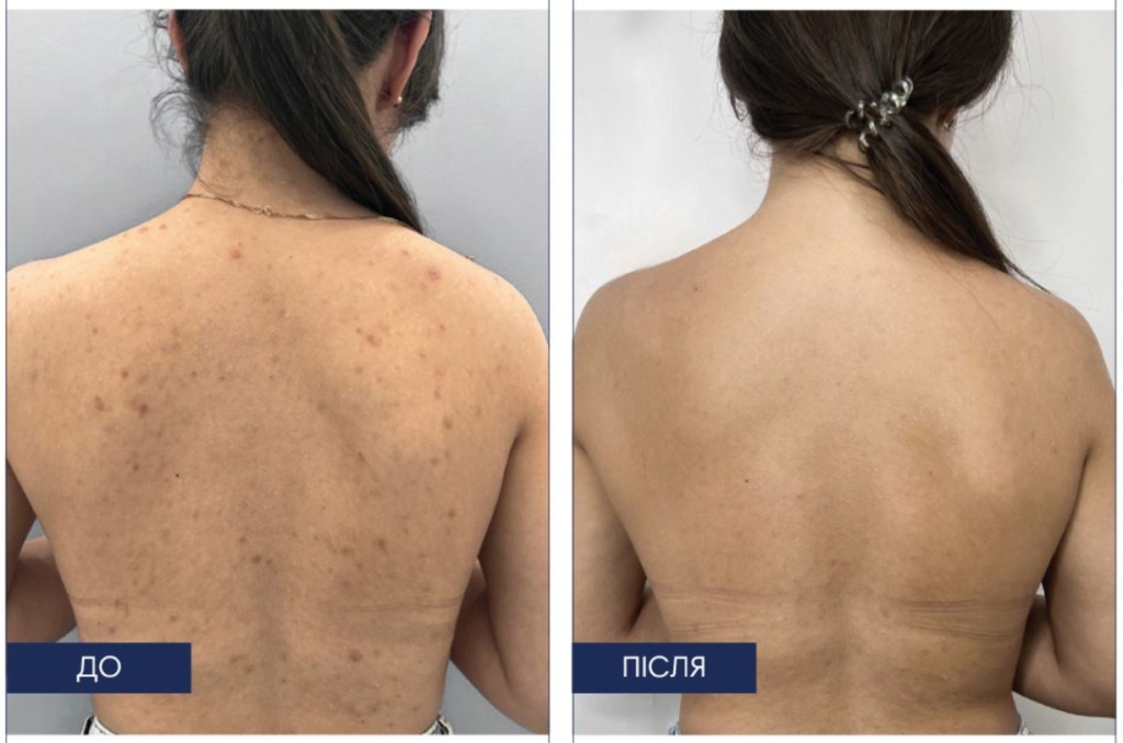 Braderm Dorsak Spray — Спрей для тіла від висипань