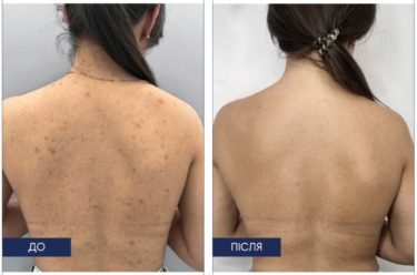 Braderm Dorsak Spray — Спрей для тіла від висипань