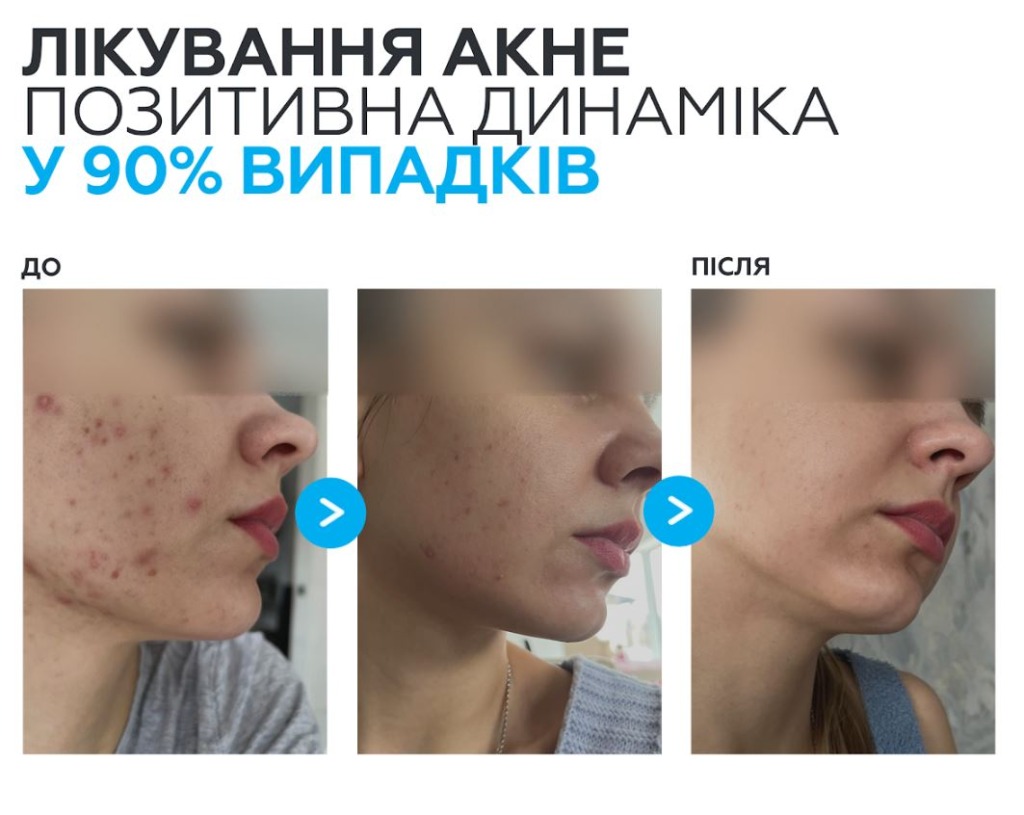 Braderm Kurac Cream — Крем від акне з бензоїлом пероксидом