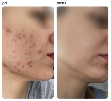Braderm Kurac Cream — Крем від акне з бензоїлом пероксидом