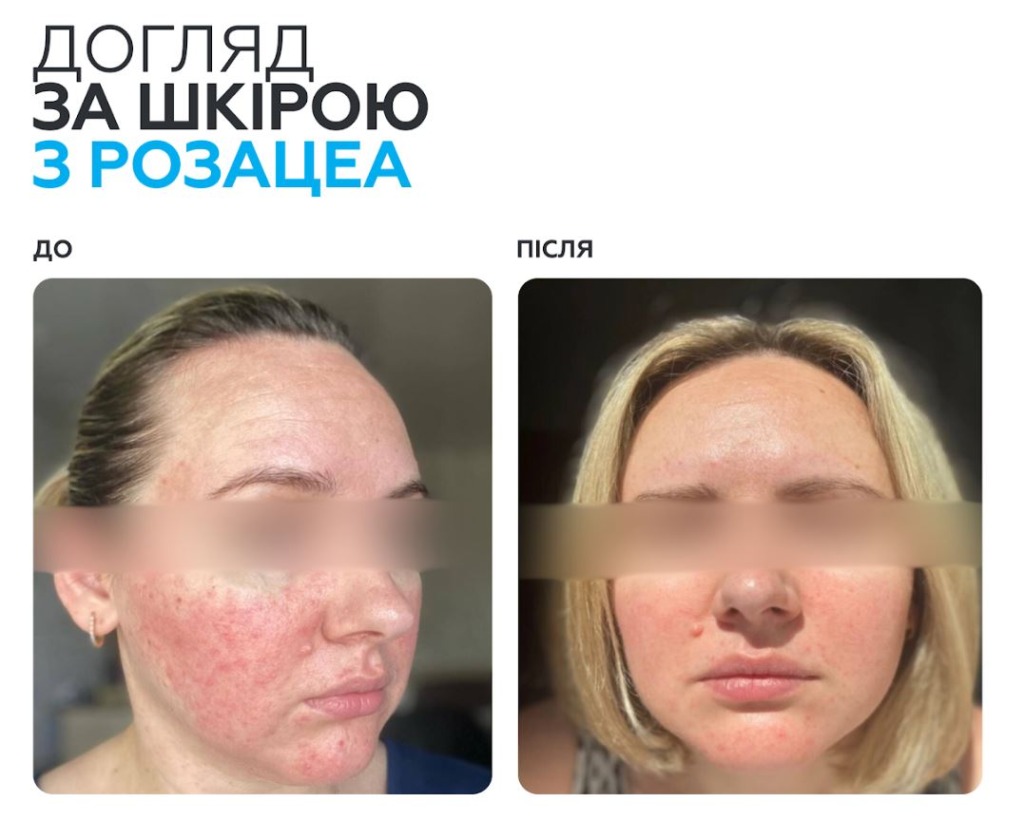 Braderm Rosac Cream — Крем із азелаїновою кислотою
