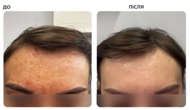 Braderm Tramexal Cream — Освітлюючий крем від пігментації