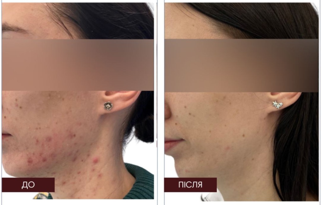 Braderm Tramexal Cream — Освітлюючий крем від пігментації