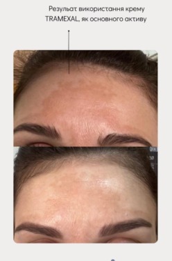 Braderm Tramexal Cream — Освітлюючий крем від пігментації