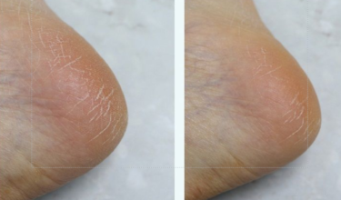 Derma:B Urea 9.8 Foot Cream — Пом’якшуючий крем для ніг з сечовиною